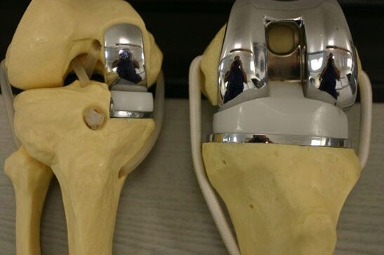 Varianti di endoprotetica dell'articolazione del ginocchio