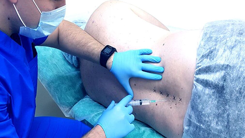 Blocco spinale per osteocondrosi