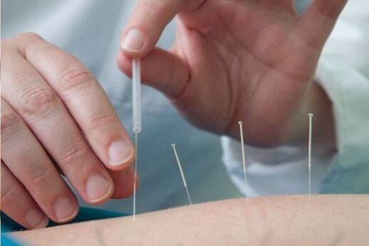 L'agopuntura è un metodo per trattare il dolore nella regione lombare causato dall'osteocondrosi