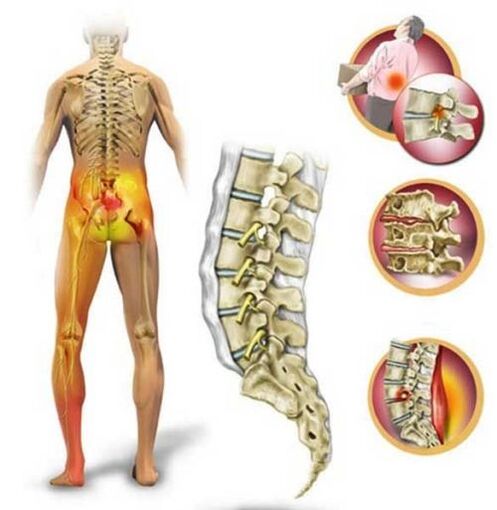 Osteocondrosi della colonna lombare, che causa dolore lombare