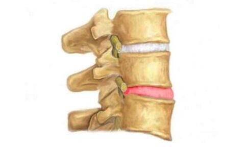 Protrusione del disco intervertebrale della colonna vertebrale - un segno di osteocondrosi