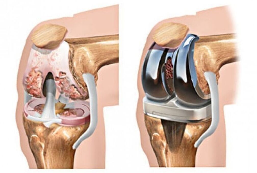 protesi di ginocchio per artrosi