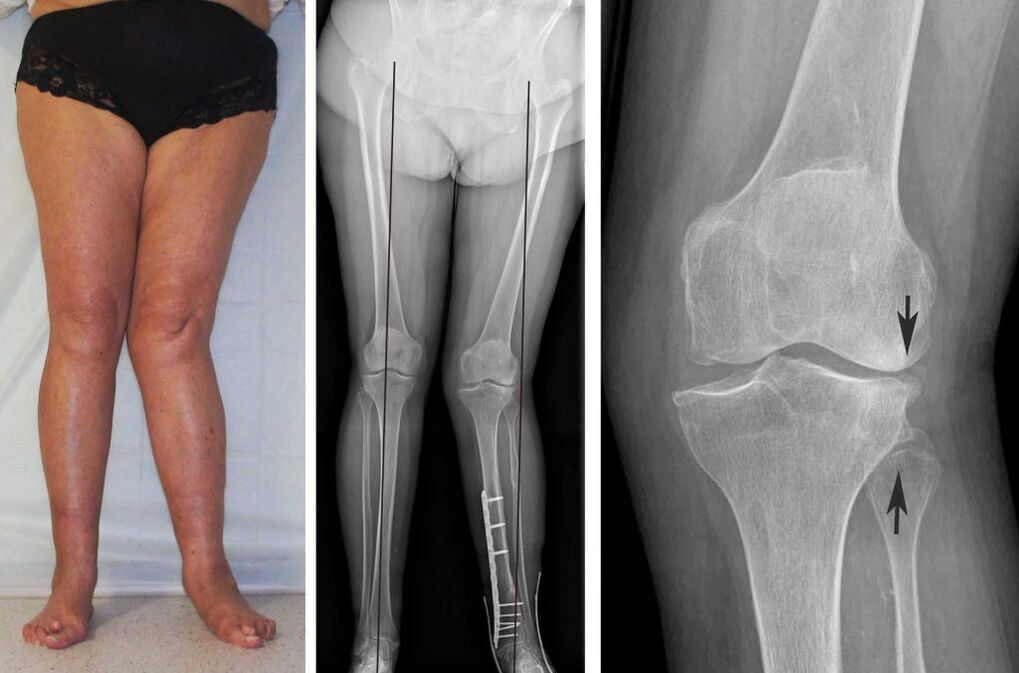 quadro clinico dell'artrosi del ginocchio
