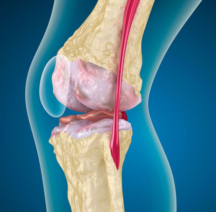 Artrosi dell'articolazione del ginocchio - una malattia degenerativa-distrofica