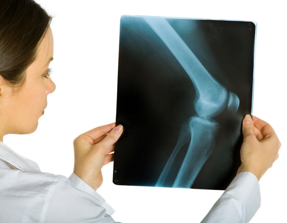 La radiografia dell'articolazione del ginocchio rivelerà la presenza di artrosi deformante